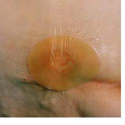 MEDICAZIONE IDROCOLLOIDALE TEGADERM HYDROCOLLOID THIN QUADRATA SENZA BORDO 10X10CM 5 PEZZI - Farmacia Murachelli Di Putelli dr. Giovanni